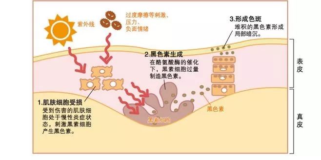 色斑这么多类型，脸上色斑怎么管理？