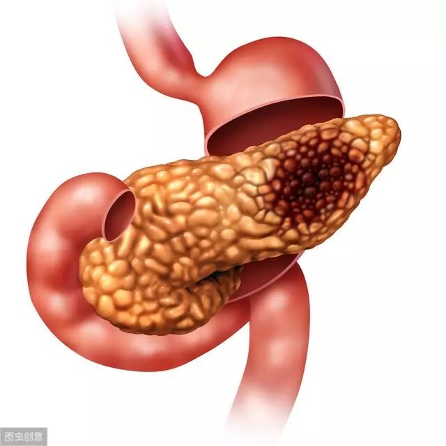 年少不知胰腺癌，当知胰腺癌已晚期，关于胰腺癌，你要懂3大症状