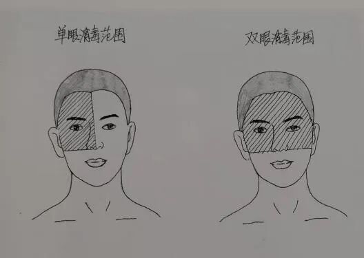 为什么要叫备皮刀“感术 ”行动 ｜｜ 院感说备皮刀不符合要求，备皮怎么办？常见备皮、消毒范围_https://www.jmylbn.com_新闻资讯_第5张