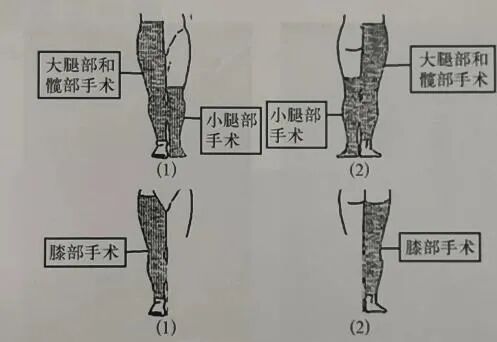 为什么要叫备皮刀“感术 ”行动 ｜｜ 院感说备皮刀不符合要求，备皮怎么办？常见备皮、消毒范围_https://www.jmylbn.com_新闻资讯_第17张