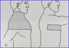为什么要叫备皮刀“感术 ”行动 ｜｜ 院感说备皮刀不符合要求，备皮怎么办？常见备皮、消毒范围_https://www.jmylbn.com_新闻资讯_第9张