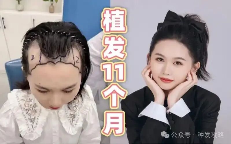 深圳女性发际线种植哪家医院好？1000毛囊单位多少多少钱？有价格表吗？