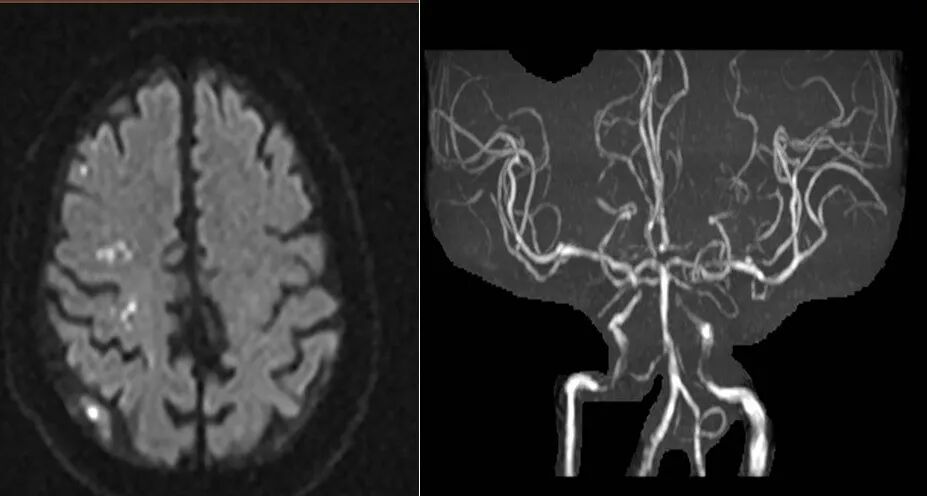 导丝怎么扩【载药时代 球扩天下】NOVA DES®颅内药物洗脱支架在颈内动脉颅内段重度狭窄的应用二例！_https://www.jmylbn.com_新闻资讯_第8张