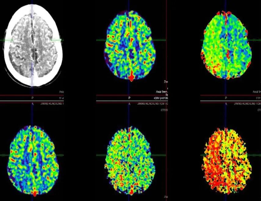 导丝怎么扩【载药时代 球扩天下】NOVA DES®颅内药物洗脱支架在颈内动脉颅内段重度狭窄的应用二例！_https://www.jmylbn.com_新闻资讯_第9张