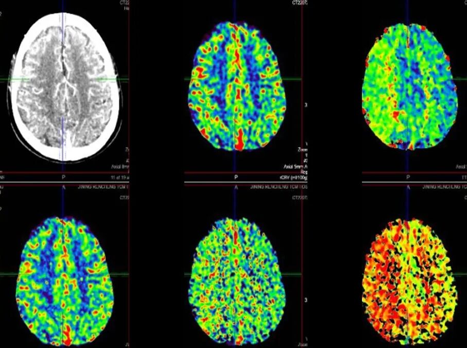 导丝怎么扩【载药时代 球扩天下】NOVA DES®颅内药物洗脱支架在颈内动脉颅内段重度狭窄的应用二例！_https://www.jmylbn.com_新闻资讯_第11张