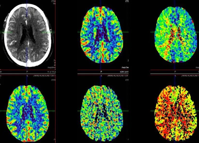 导丝怎么扩【载药时代 球扩天下】NOVA DES®颅内药物洗脱支架在颈内动脉颅内段重度狭窄的应用二例！_https://www.jmylbn.com_新闻资讯_第12张