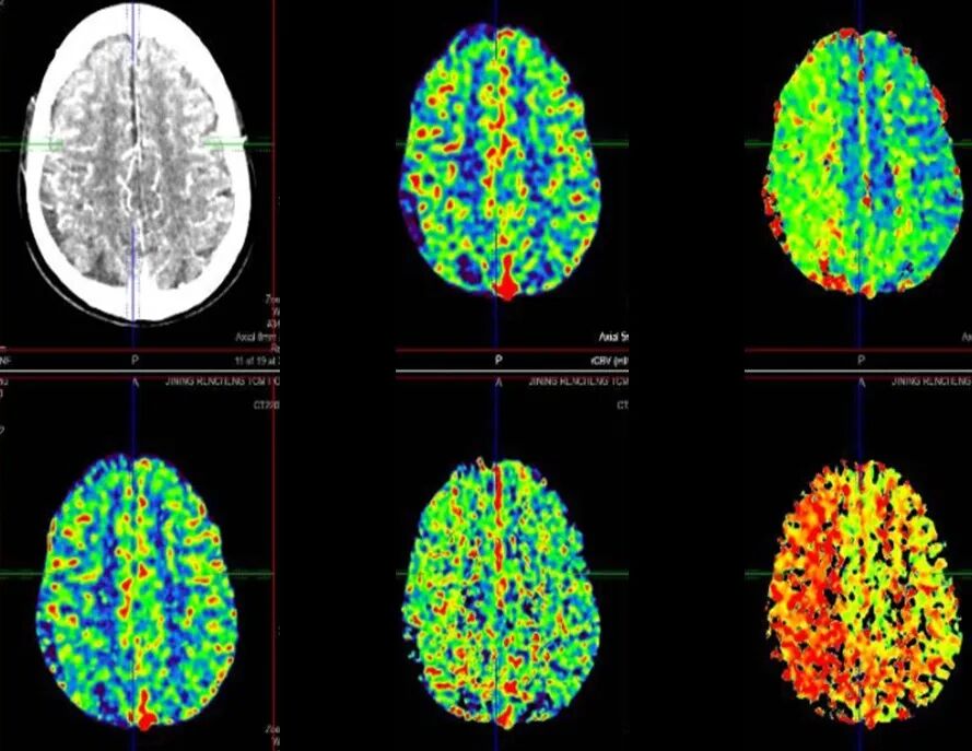 导丝怎么扩【载药时代 球扩天下】NOVA DES®颅内药物洗脱支架在颈内动脉颅内段重度狭窄的应用二例！_https://www.jmylbn.com_新闻资讯_第10张