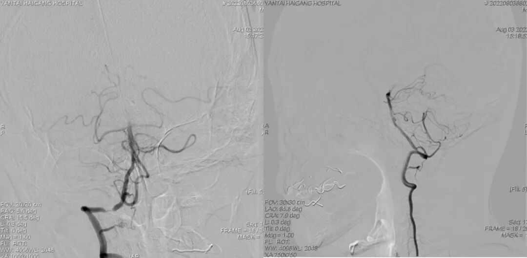 导丝怎么扩【载药时代 球扩天下】NOVA DES®颅内药物洗脱支架在椎动脉颅内段重度狭窄的应用二例_https://www.jmylbn.com_新闻资讯_第29张