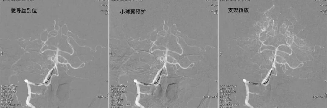 导丝怎么扩【载药时代 球扩天下】NOVA DES®颅内药物洗脱支架在椎动脉颅内段重度狭窄的应用二例_https://www.jmylbn.com_新闻资讯_第33张