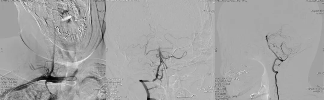 导丝怎么扩【载药时代 球扩天下】NOVA DES®颅内药物洗脱支架在椎动脉颅内段重度狭窄的应用二例_https://www.jmylbn.com_新闻资讯_第18张