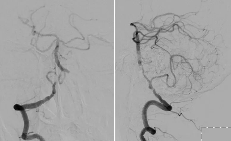 导丝怎么扩【载药时代 球扩天下】NOVA DES®颅内药物洗脱支架在椎动脉颅内段重度狭窄的应用二例_https://www.jmylbn.com_新闻资讯_第6张
