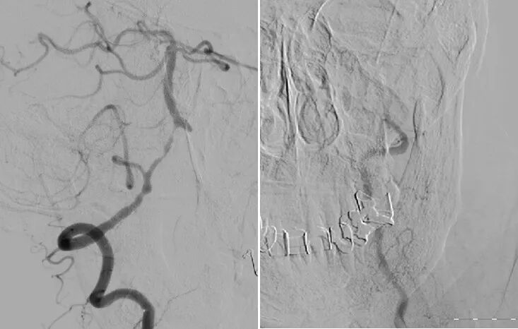 导丝怎么扩【载药时代 球扩天下】NOVA DES®颅内药物洗脱支架在椎动脉颅内段重度狭窄的应用二例_https://www.jmylbn.com_新闻资讯_第7张