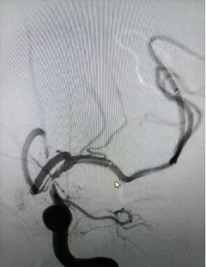 导丝怎么扩【载药时代 球扩天下】NOVA DES®颅内药物洗脱支架在颈内动脉颅内段重度狭窄的应用两例！滕州市中心医院&山西医科大学第二医院_https://www.jmylbn.com_新闻资讯_第5张
