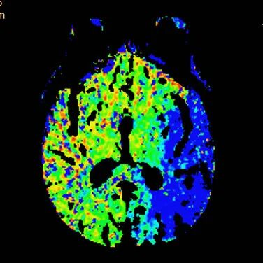 动脉长鞘怎么置入【沙场点兵 有史可鉴】Trevo ProVue联合Infinity长鞘经桡动脉取栓分享_https://www.jmylbn.com_新闻资讯_第7张