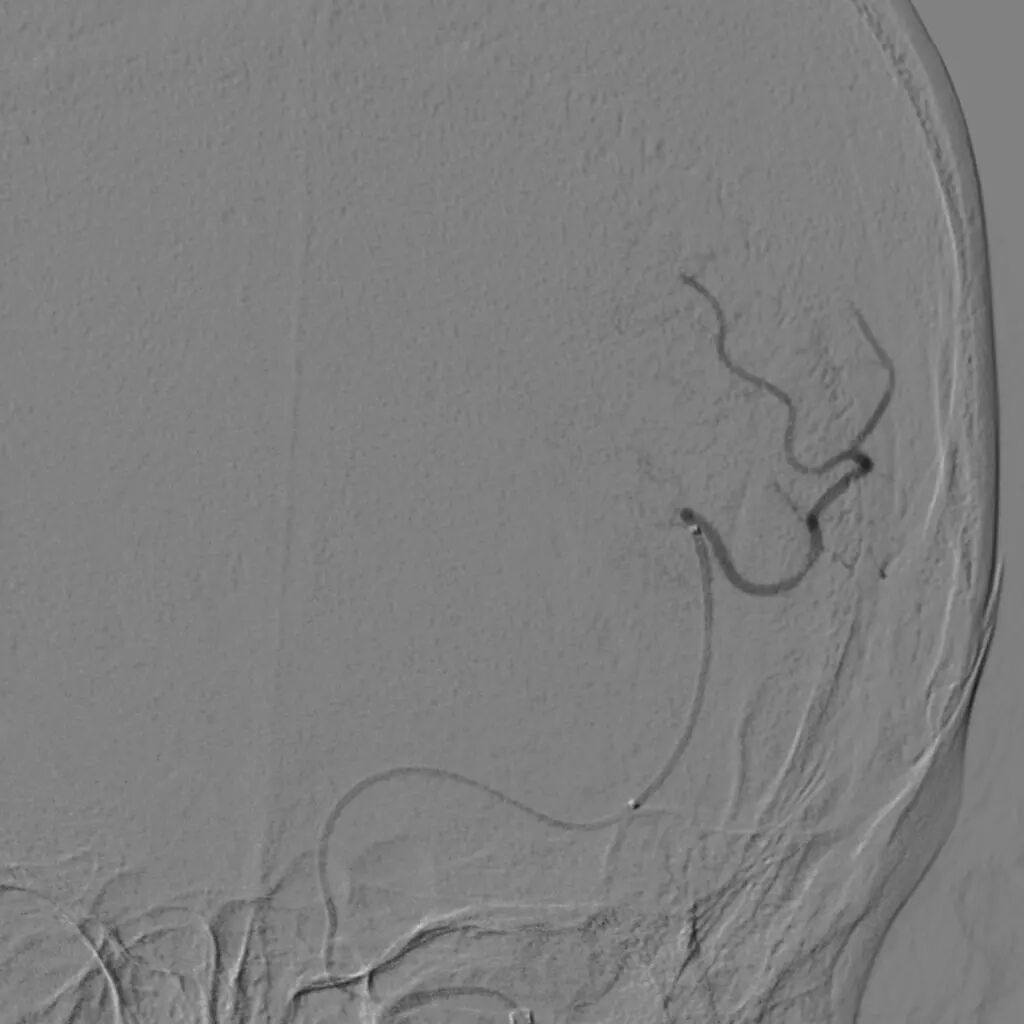 动脉长鞘怎么置入【沙场点兵 有史可鉴】Trevo ProVue联合Infinity长鞘经桡动脉取栓分享_https://www.jmylbn.com_新闻资讯_第15张