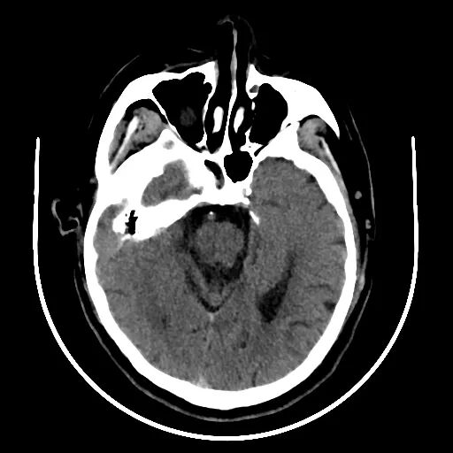 动脉长鞘怎么置入【沙场点兵 有史可鉴】Trevo ProVue联合Infinity长鞘经桡动脉取栓分享_https://www.jmylbn.com_新闻资讯_第3张