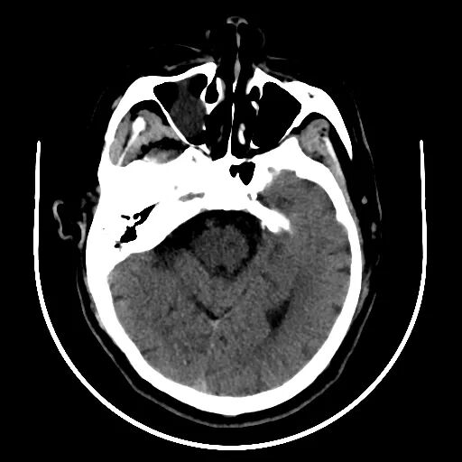 动脉长鞘怎么置入【沙场点兵 有史可鉴】Trevo ProVue联合Infinity长鞘经桡动脉取栓分享_https://www.jmylbn.com_新闻资讯_第2张