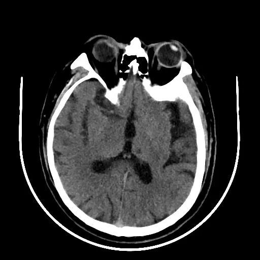 动脉长鞘怎么置入【沙场点兵 有史可鉴】Trevo ProVue联合Infinity长鞘经桡动脉取栓分享_https://www.jmylbn.com_新闻资讯_第4张