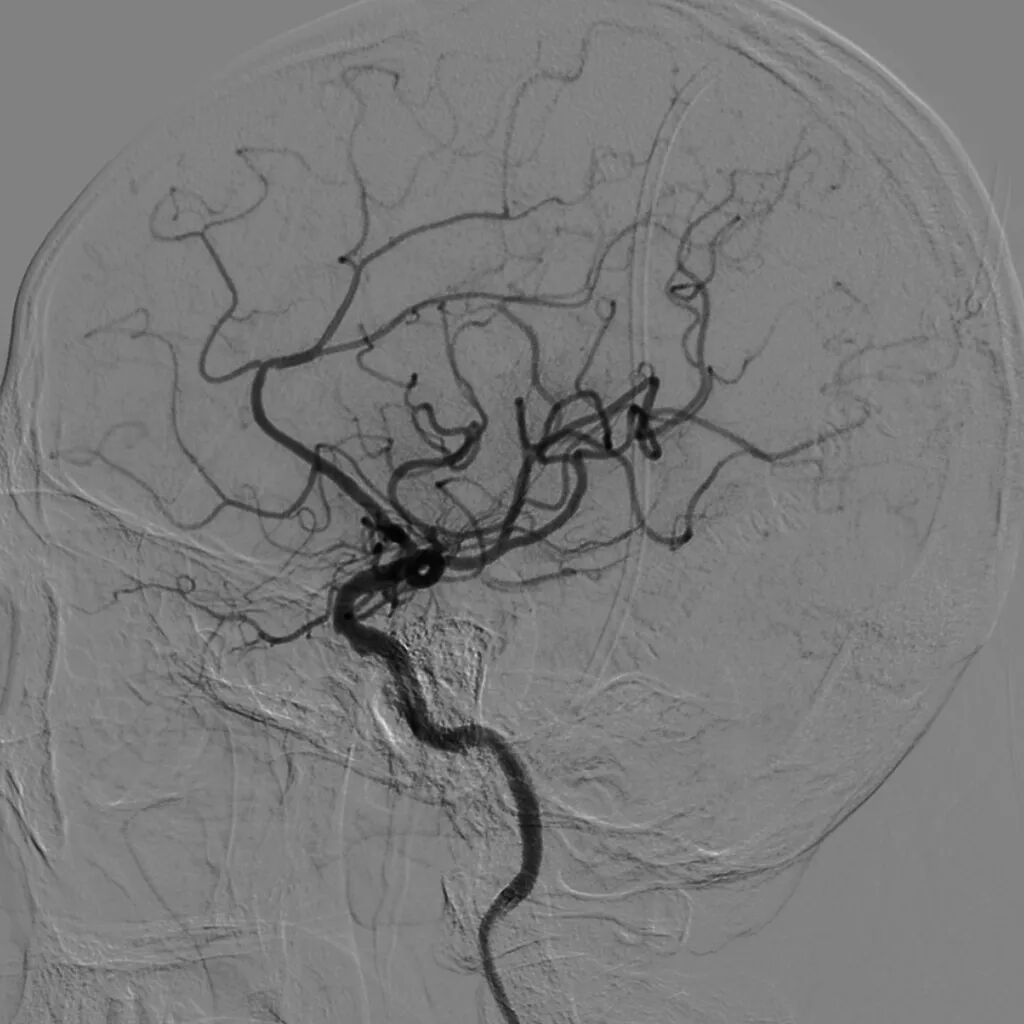 动脉长鞘怎么置入【沙场点兵 有史可鉴】Trevo ProVue联合Infinity长鞘经桡动脉取栓分享_https://www.jmylbn.com_新闻资讯_第19张