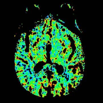 动脉长鞘怎么置入【沙场点兵 有史可鉴】Trevo ProVue联合Infinity长鞘经桡动脉取栓分享_https://www.jmylbn.com_新闻资讯_第10张