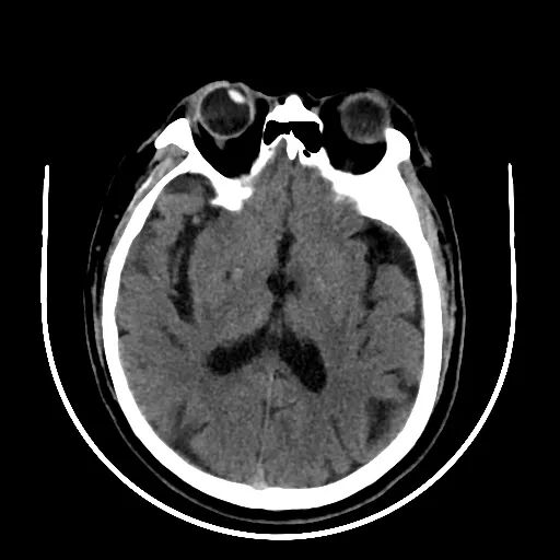 动脉长鞘怎么置入【沙场点兵 有史可鉴】Trevo ProVue联合Infinity长鞘经桡动脉取栓分享_https://www.jmylbn.com_新闻资讯_第5张