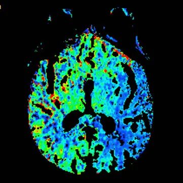 动脉长鞘怎么置入【沙场点兵 有史可鉴】Trevo ProVue联合Infinity长鞘经桡动脉取栓分享_https://www.jmylbn.com_新闻资讯_第9张