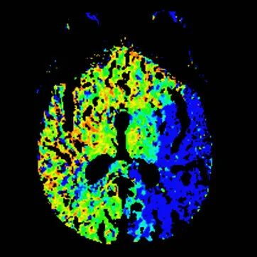 动脉长鞘怎么置入【沙场点兵 有史可鉴】Trevo ProVue联合Infinity长鞘经桡动脉取栓分享_https://www.jmylbn.com_新闻资讯_第8张