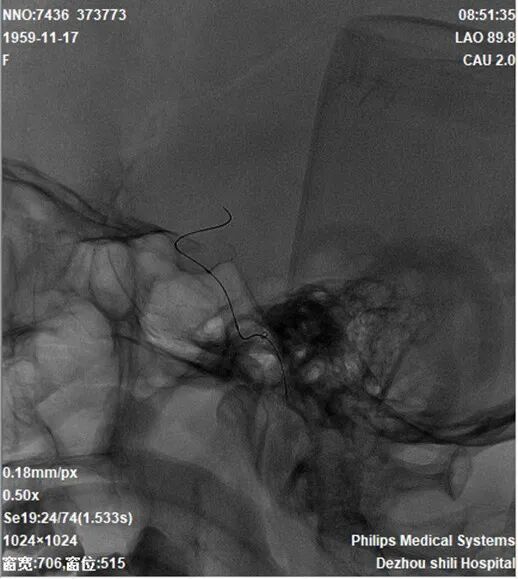 导丝怎么扩【载药时代 球扩天下】NOVA DES®颅内药物洗脱支架在颈内动脉颅内段重度狭窄的应用二例！_https://www.jmylbn.com_新闻资讯_第28张