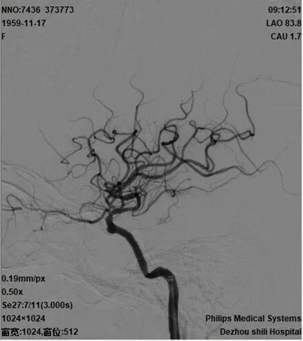 导丝怎么扩【载药时代 球扩天下】NOVA DES®颅内药物洗脱支架在颈内动脉颅内段重度狭窄的应用二例！_https://www.jmylbn.com_新闻资讯_第32张