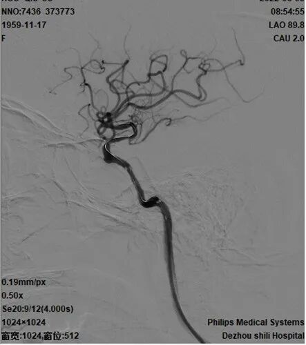导丝怎么扩【载药时代 球扩天下】NOVA DES®颅内药物洗脱支架在颈内动脉颅内段重度狭窄的应用二例！_https://www.jmylbn.com_新闻资讯_第30张