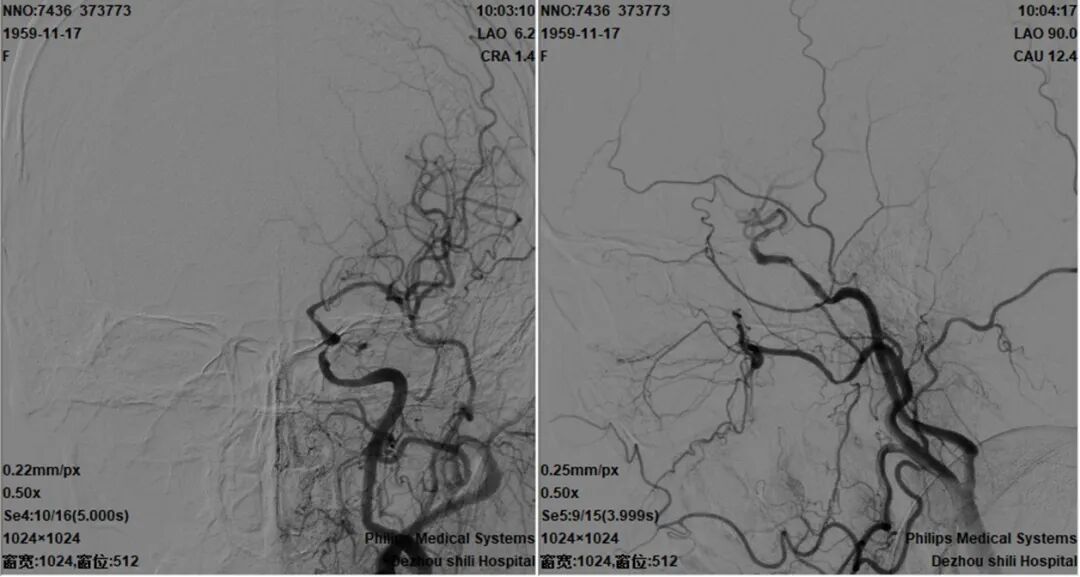 导丝怎么扩【载药时代 球扩天下】NOVA DES®颅内药物洗脱支架在颈内动脉颅内段重度狭窄的应用二例！_https://www.jmylbn.com_新闻资讯_第27张