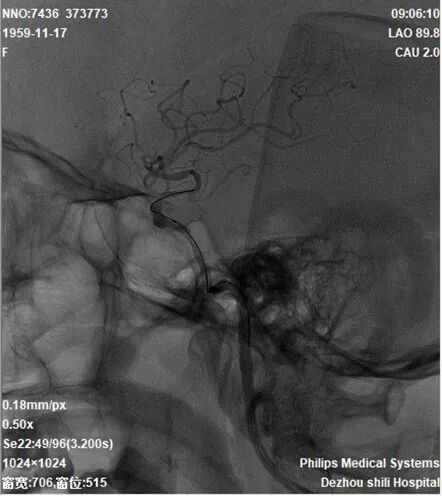 导丝怎么扩【载药时代 球扩天下】NOVA DES®颅内药物洗脱支架在颈内动脉颅内段重度狭窄的应用二例！_https://www.jmylbn.com_新闻资讯_第31张