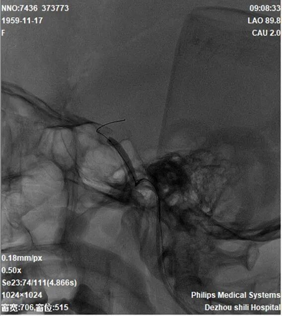 导丝怎么扩【载药时代 球扩天下】NOVA DES®颅内药物洗脱支架在颈内动脉颅内段重度狭窄的应用二例！_https://www.jmylbn.com_新闻资讯_第29张