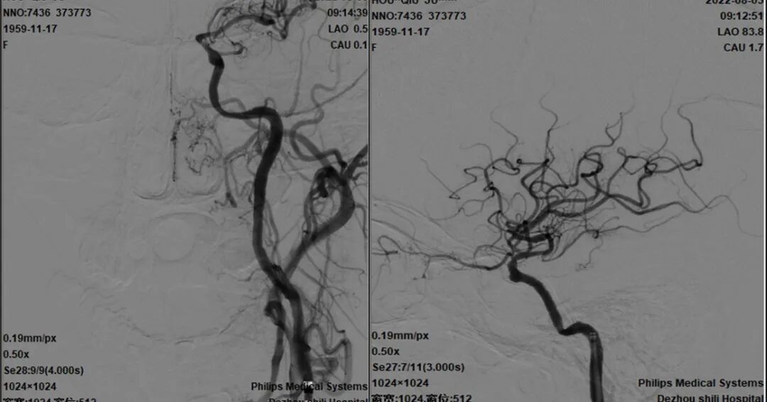 导丝怎么扩【载药时代 球扩天下】NOVA DES®颅内药物洗脱支架在颈内动脉颅内段重度狭窄的应用二例！_https://www.jmylbn.com_新闻资讯_第33张