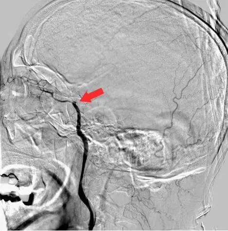 什么叫桡鞘【例久弥新】寻道于桡——瑞康通5.5F Introsky X导管鞘经桡取栓一例_https://www.jmylbn.com_新闻资讯_第12张