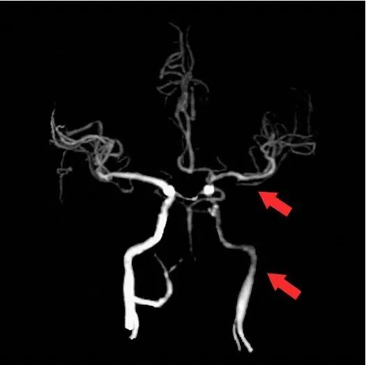 什么叫桡鞘【例久弥新】寻道于桡——瑞康通5.5F Introsky X导管鞘经桡取栓一例_https://www.jmylbn.com_新闻资讯_第5张