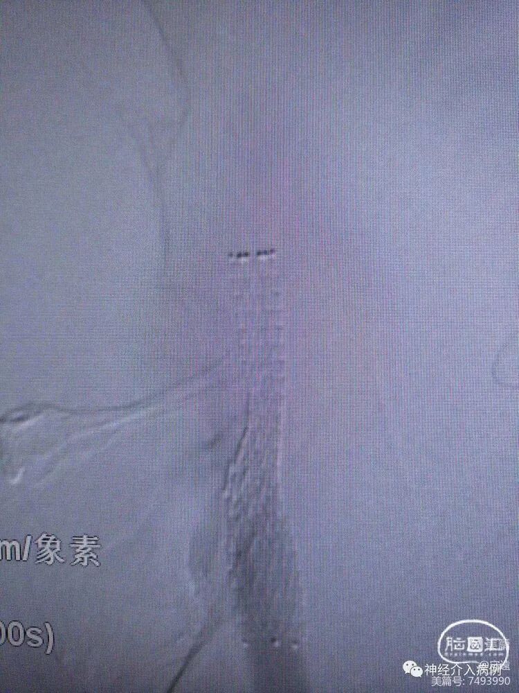 动脉长鞘怎么置入【病例夹】迷走反射的思考一一颈动脉支架置入术后和拔除动脉鞘后迷走反射中西医结合应对策略_https://www.jmylbn.com_新闻资讯_第5张