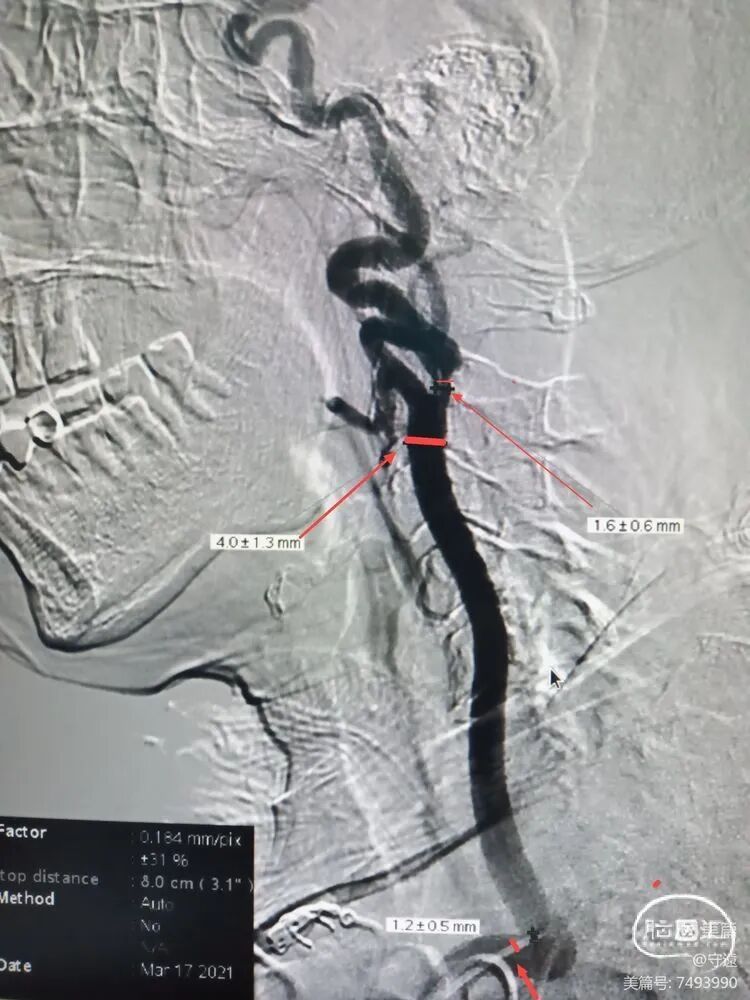 动脉长鞘怎么置入【病例夹】迷走反射的思考一一颈动脉支架置入术后和拔除动脉鞘后迷走反射中西医结合应对策略_https://www.jmylbn.com_新闻资讯_第16张