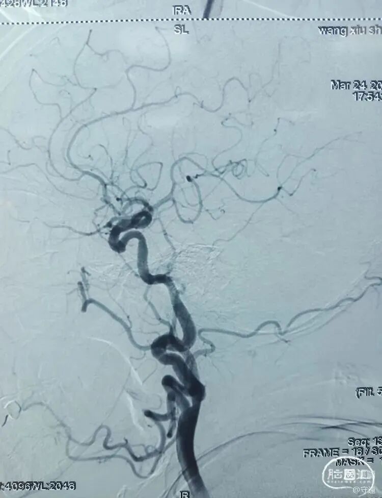 动脉长鞘怎么置入【病例夹】迷走反射的思考一一颈动脉支架置入术后和拔除动脉鞘后迷走反射中西医结合应对策略_https://www.jmylbn.com_新闻资讯_第17张