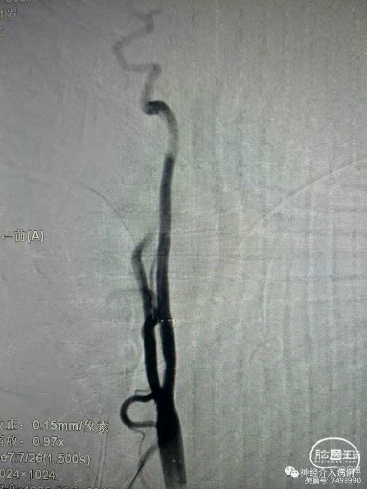 动脉长鞘怎么置入【病例夹】迷走反射的思考一一颈动脉支架置入术后和拔除动脉鞘后迷走反射中西医结合应对策略_https://www.jmylbn.com_新闻资讯_第6张