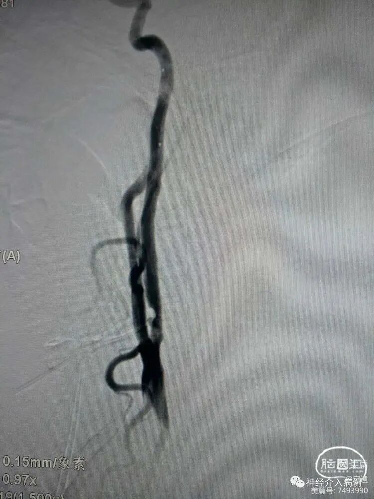 动脉长鞘怎么置入【病例夹】迷走反射的思考一一颈动脉支架置入术后和拔除动脉鞘后迷走反射中西医结合应对策略_https://www.jmylbn.com_新闻资讯_第4张