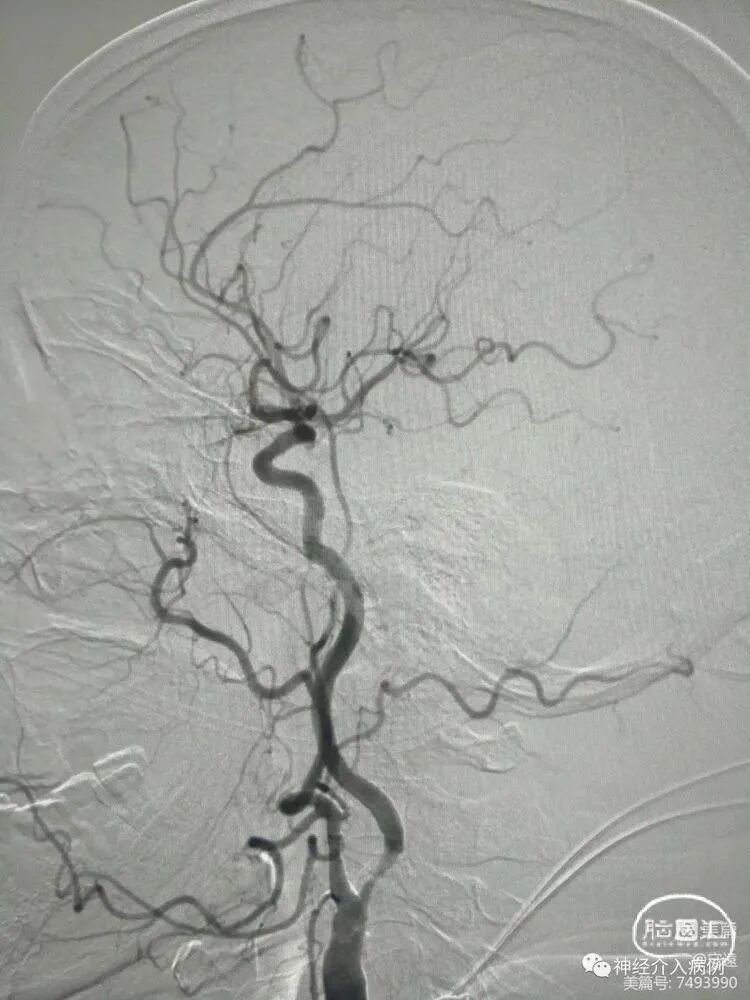 动脉长鞘怎么置入【病例夹】迷走反射的思考一一颈动脉支架置入术后和拔除动脉鞘后迷走反射中西医结合应对策略_https://www.jmylbn.com_新闻资讯_第10张