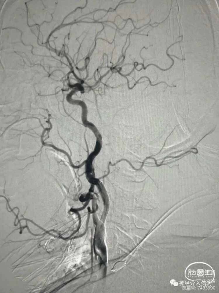 动脉长鞘怎么置入【病例夹】迷走反射的思考一一颈动脉支架置入术后和拔除动脉鞘后迷走反射中西医结合应对策略_https://www.jmylbn.com_新闻资讯_第13张