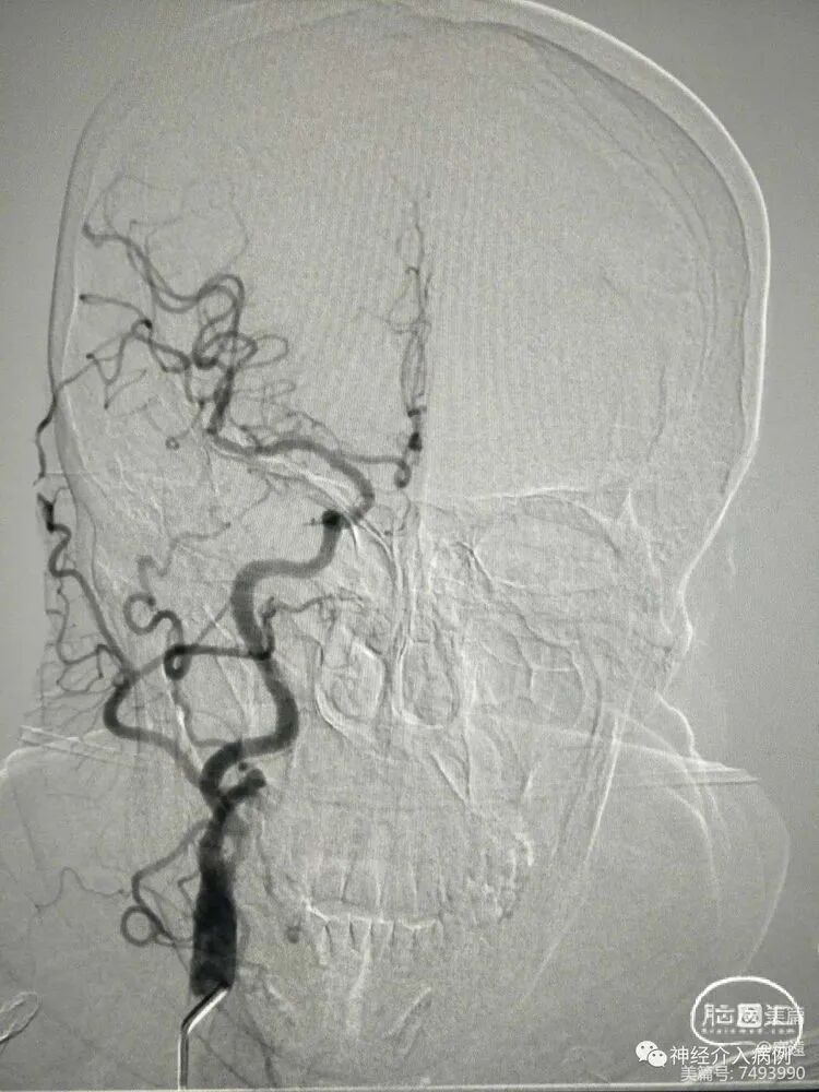 动脉长鞘怎么置入【病例夹】迷走反射的思考一一颈动脉支架置入术后和拔除动脉鞘后迷走反射中西医结合应对策略_https://www.jmylbn.com_新闻资讯_第14张