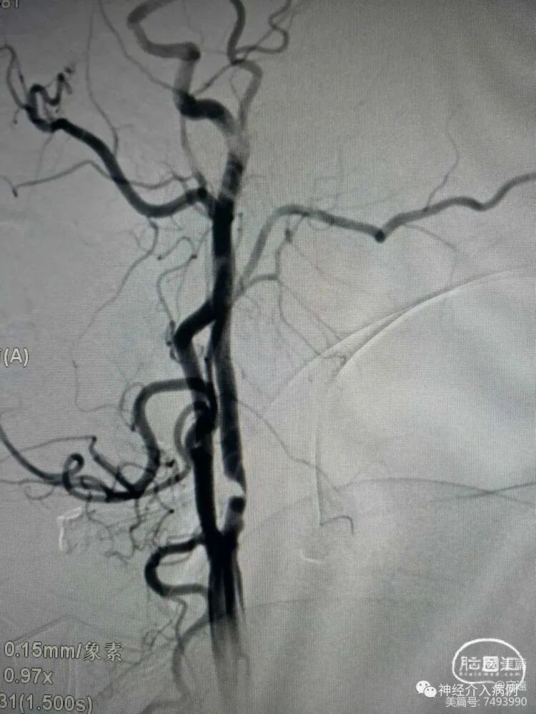 动脉长鞘怎么置入【病例夹】迷走反射的思考一一颈动脉支架置入术后和拔除动脉鞘后迷走反射中西医结合应对策略_https://www.jmylbn.com_新闻资讯_第3张