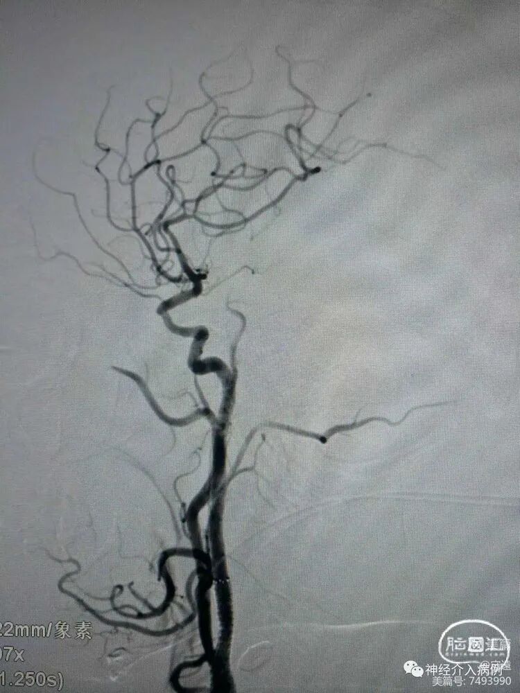 动脉长鞘怎么置入【病例夹】迷走反射的思考一一颈动脉支架置入术后和拔除动脉鞘后迷走反射中西医结合应对策略_https://www.jmylbn.com_新闻资讯_第8张