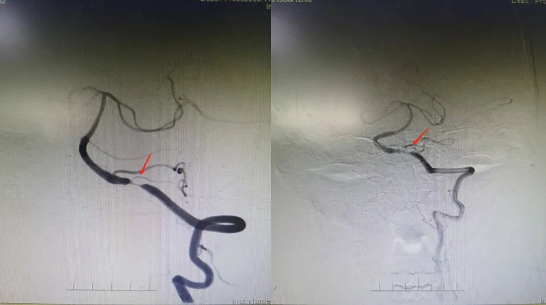 导丝怎么扩【载药时代 球扩天下】NOVA DES®颅内药物洗脱支架在症状性颅内动脉狭窄中的应用—烟台鲁东医院使用体会二例！_https://www.jmylbn.com_新闻资讯_第6张