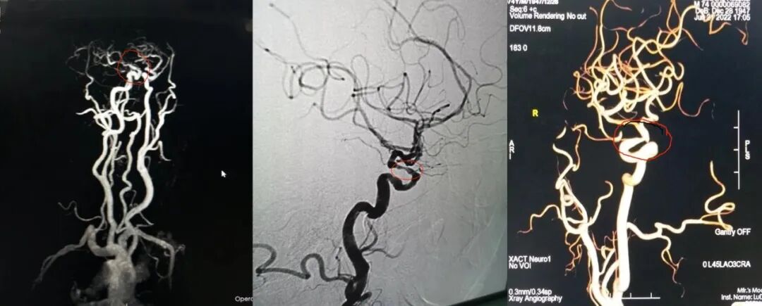 导丝怎么扩【载药时代 球扩天下】NOVA DES®颅内药物洗脱支架在症状性颅内动脉狭窄中的应用—烟台鲁东医院使用体会二例！_https://www.jmylbn.com_新闻资讯_第19张