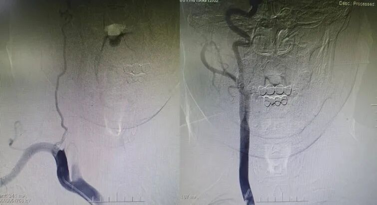 导丝怎么扩【载药时代 球扩天下】NOVA DES®颅内药物洗脱支架在症状性颅内动脉狭窄中的应用—烟台鲁东医院使用体会二例！_https://www.jmylbn.com_新闻资讯_第4张