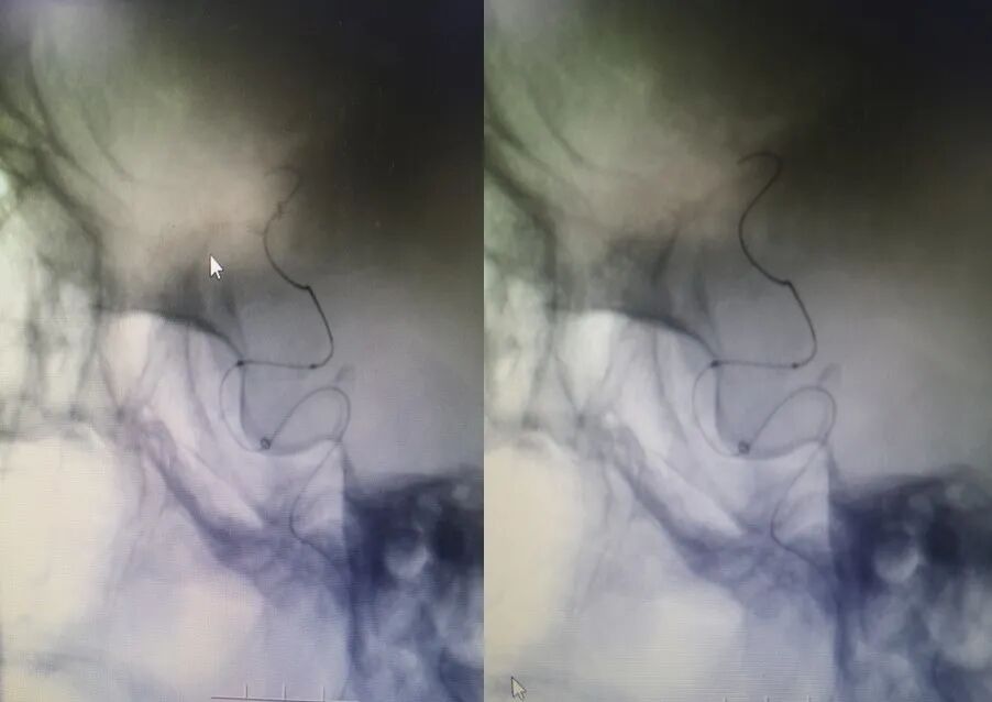 导丝怎么扩【载药时代 球扩天下】NOVA DES®颅内药物洗脱支架在症状性颅内动脉狭窄中的应用—烟台鲁东医院使用体会二例！_https://www.jmylbn.com_新闻资讯_第22张